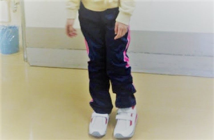 尖足手術後の立位